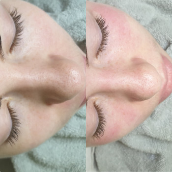 3Д чистка лица. Процедура безболезненный. Эффективно борется