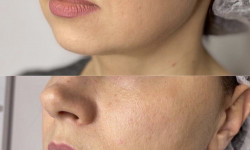 RF ліфтинг обличчя та тіла Косметологический центр O.L.Beauty Киев