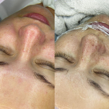 Чистка лица