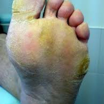 Натоптыши,мозоли