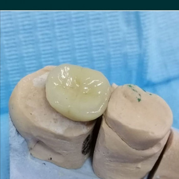 Металокерамічні коронки
                    Стоматолог Алексей Киев