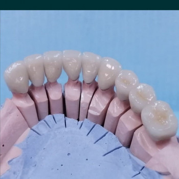 Металокерамічні коронки
                    Стоматолог Алексей Киев