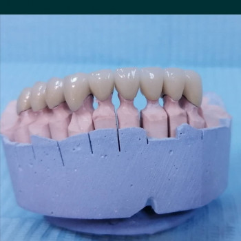 Металокерамічні коронки
                    Стоматолог Алексей Киев