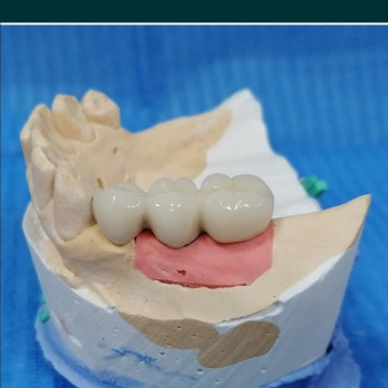 Металокерамічні коронки
                    Стоматолог Алексей Киев