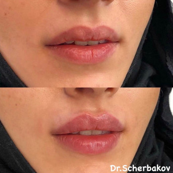 Контурная пластика лица (филлеры)
                    Косметологічний центр Нью Медикал Київ