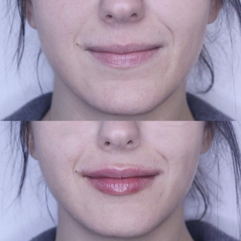 Коррекция губ.