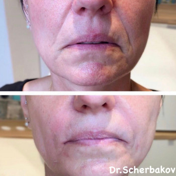 Коррекция носогубных складок.