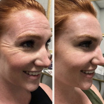 Ботокс - коррекция морщин
                    Косметологічний центр Нью Медикал Київ