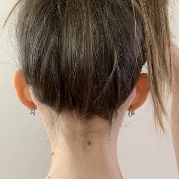 Отопластика