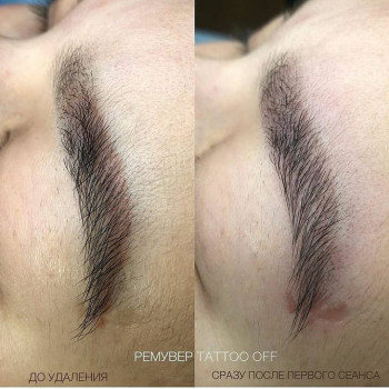 Полное удаление татуажа ремувером Tattoo Off
                    Бровист Ольга Мариуполь