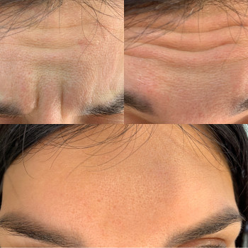 Ботулинотерапия
                    Косметологический центр Celebriti Черкассы