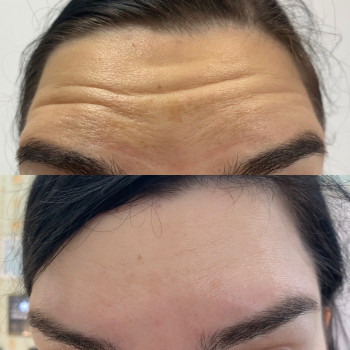 Ботулинотерапия
                    Косметологический центр Celebriti Черкассы