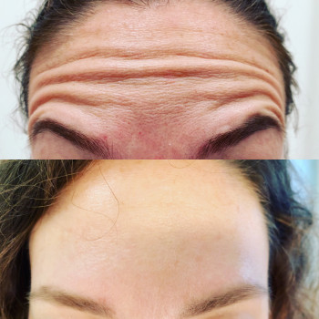 Ботулинотерапия
                    Косметологический центр Celebriti Черкассы