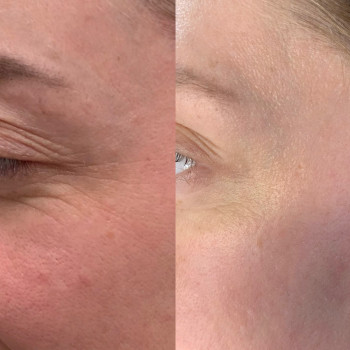 Ботулинотерапия
                    Косметологический центр Celebriti Черкассы