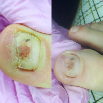 Механическое повреждение ногтевой пластины с выявленным оних