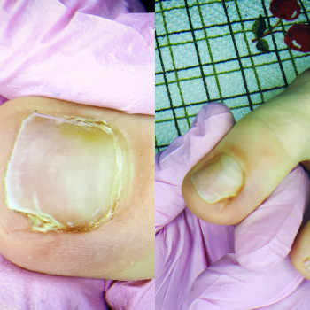 Аппаратная чистка онихолизиса.