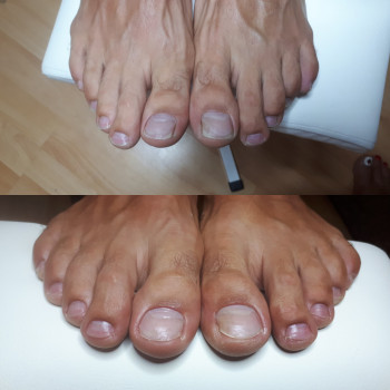 Мужской педикюр является эффективным средством лечения и про