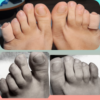 Аппаратный педикюр 
Плюс разгрузка на пальцах.