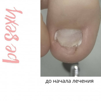 вросший ноготь