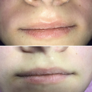 Депиляция над верхней губой.Усики