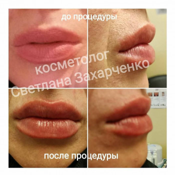 збільшення губ 