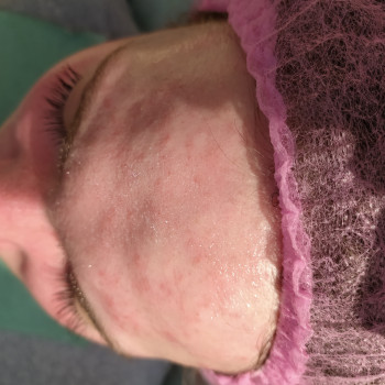 Чистка обличчя
                    Врач-косметолог Тетяна Луцк