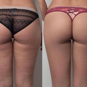 Обёртывание STYX
                    Косметолог-ін'єкціоніст Лилия Київ