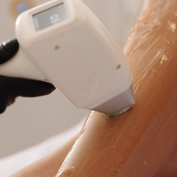 Лазерная эпиляция
                    Косметолог-ін'єкціоніст Лилия Київ