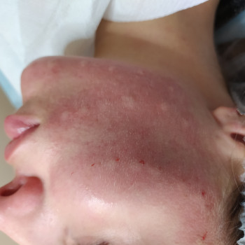 Мезотерапія
                    Врач-косметолог Тетяна Луцк