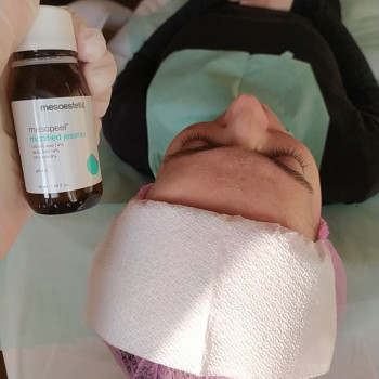 Пілінг
                    Лікар-косметолог Тетяна Луцьк