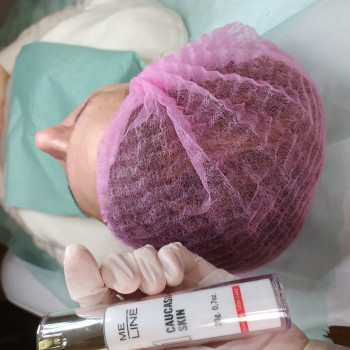 Пілінг
                    Лікар-косметолог Тетяна Луцьк