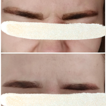 Ботулінотерапія
                    Лікар-косметолог Тетяна Луцьк