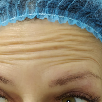 Ботулінотерапія
                    Лікар-косметолог Тетяна Луцьк