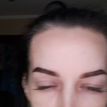 Ботулінотерапія
                    Лікар-косметолог Тетяна Луцьк