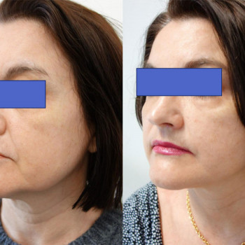 Smas Lifting нижней трети по лучшей цене!
                    Косметолог-ін'єкціоніст Лилия Київ