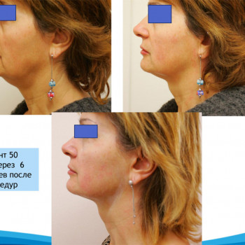 Smas Lifting нижней трети по лучшей цене!
                    Косметолог-ін'єкціоніст Лилия Київ