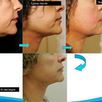 Smas Lifting нижней трети по лучшей цене!
                    Косметолог-ін'єкціоніст Лилия Київ