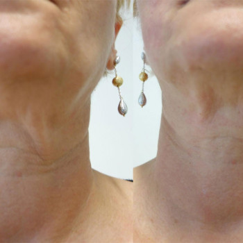 Smas Lifting нижней трети по лучшей цене!
                    Косметолог-ін'єкціоніст Лилия Київ