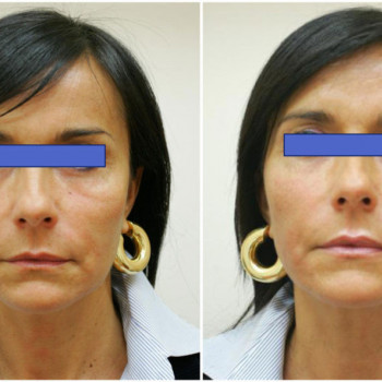 Smas Lifting нижней трети по лучшей цене!
                    Косметолог-ін'єкціоніст Лилия Київ