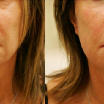 Smas Lifting нижней трети по лучшей цене!
                    Косметолог-ін'єкціоніст Лилия Київ