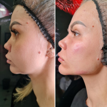 Контурная пластика