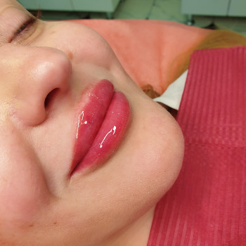 Аугментация губ