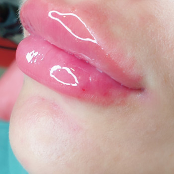 Аугментация губ