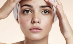 Салициловый пилинг Косметологічний центр O.L.Beauty Київ