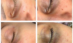 Mesoeye. Мезотерапія від темних кругів під очима, мішків, зморшок Косметолог-ін'єкціоніст Любов Тернопіль
