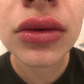 Контурна пластика обличчя
                    Косметолог-инъекционист Надія Львов