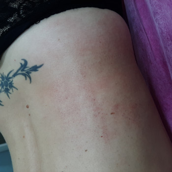 Антицеллюлитный массаж