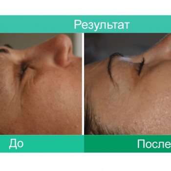 До и после процедуры
 
 
 