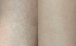 Лазерная эпиляция Тату салон ALICE tattoo studio Запорожье