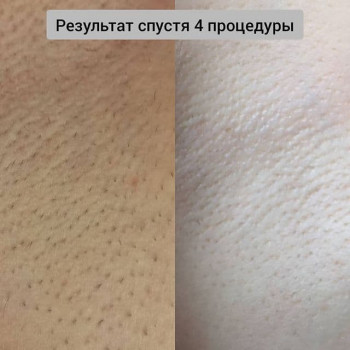 Лазерна епіляція
                    Тату салон ALICE tattoo studio Запоріжжя